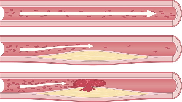 La progression de l’athérosclérose illustrée par l’intérieur de troisquatre artères : une artère normale qui accumule de la plaque au point de former un thrombus.