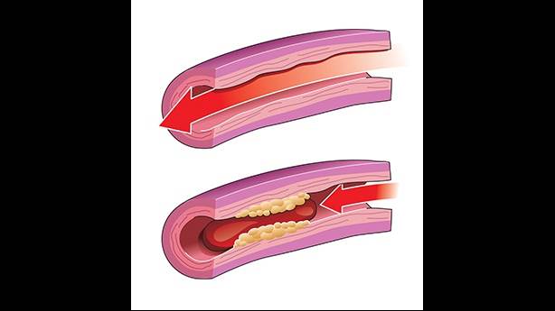 <p><p></p></p><p>Circulation sanguine normale dans l’artère saine (en haut) et circulation sanguine bloquée dans une artère présentant une accumulation de plaque jaune et un caillot de sang rouge (en bas).</p>