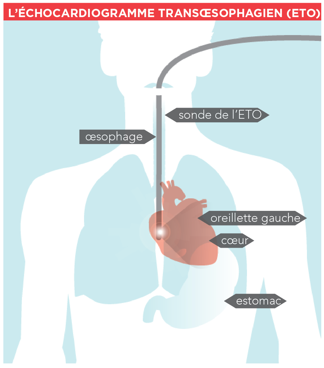 Illustration d'un échocardiogramme transoesophagien (ETO)