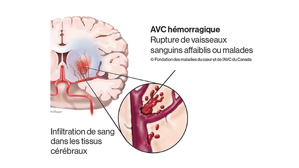 Cerveau et superposition d’une rupture de vaisseaux sanguins. Rupture de vaisseaux sanguins affaiblis/malades.  Fuite de sang dans les tissus cérébraux.  ©Fondation des maladies du coeur et de l’AVC du Canada