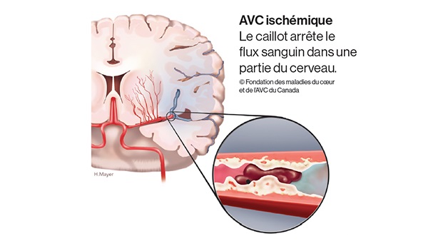 Cerveau et superposition des vaisseaux sanguins bloqués. Le caillot arrête le flux sanguin dans une partie du cerveau.  ©Fondation des maladies du coeur et de l’AVC du Canada