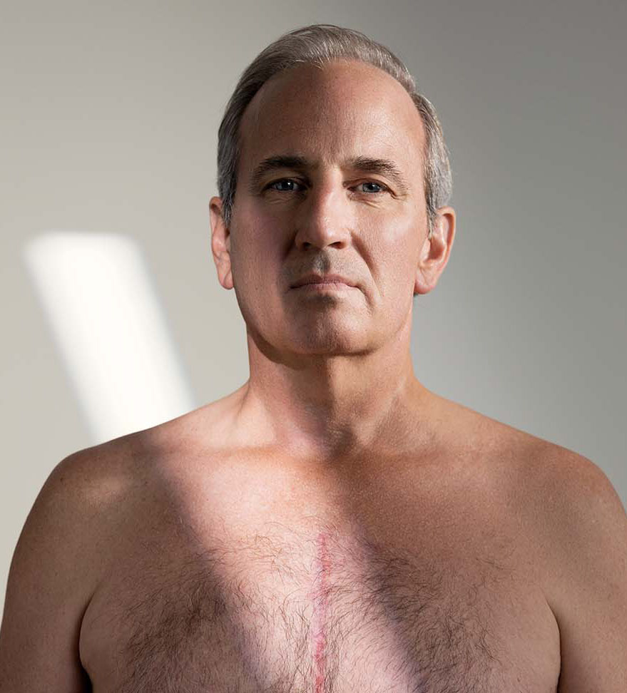 Paul King montre la cicatrice de l’incision pratiquée lors de sa chirurgie cardiaque.