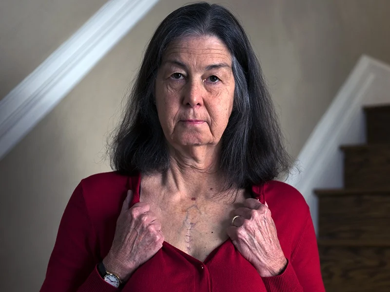Donna Hart, survivante d’une maladie du cœur, montrant sur sa poitrine la cicatrice de l’incision pratiquée pendant son opération