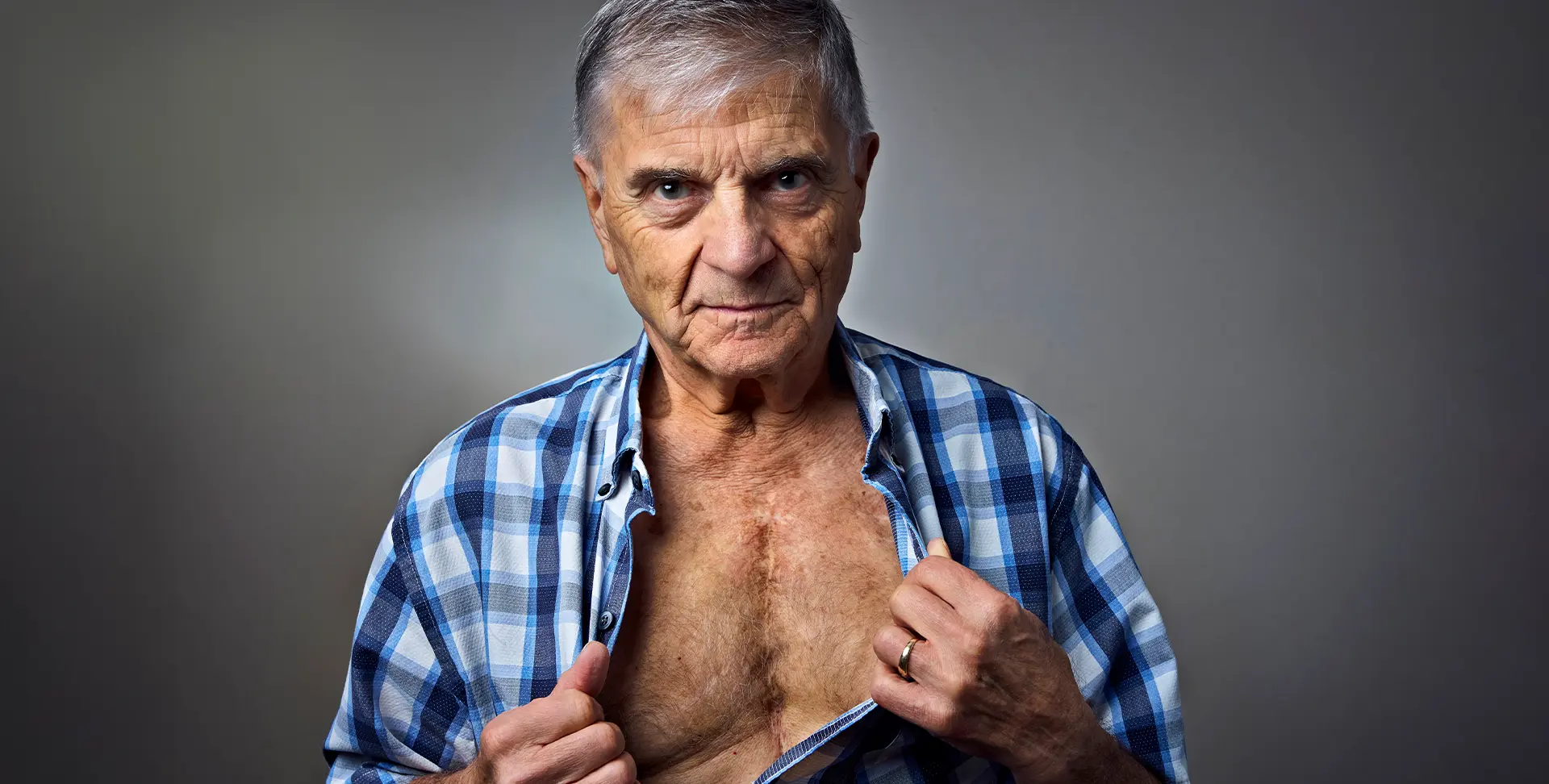 John Wheatcroft, qui vit avec une cardiopathie congénitale, montre la cicatrice sur sa poitrine.