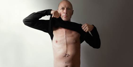 Maciej Toporowicz montre sa cicatrice d'une chirurgie à cœur ouvert.