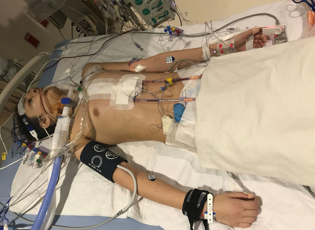 Olivier Lanthier est inconscient dans un lit d'hôpital avec des tubes et des fils connectés à son visage et à sa poitrine.