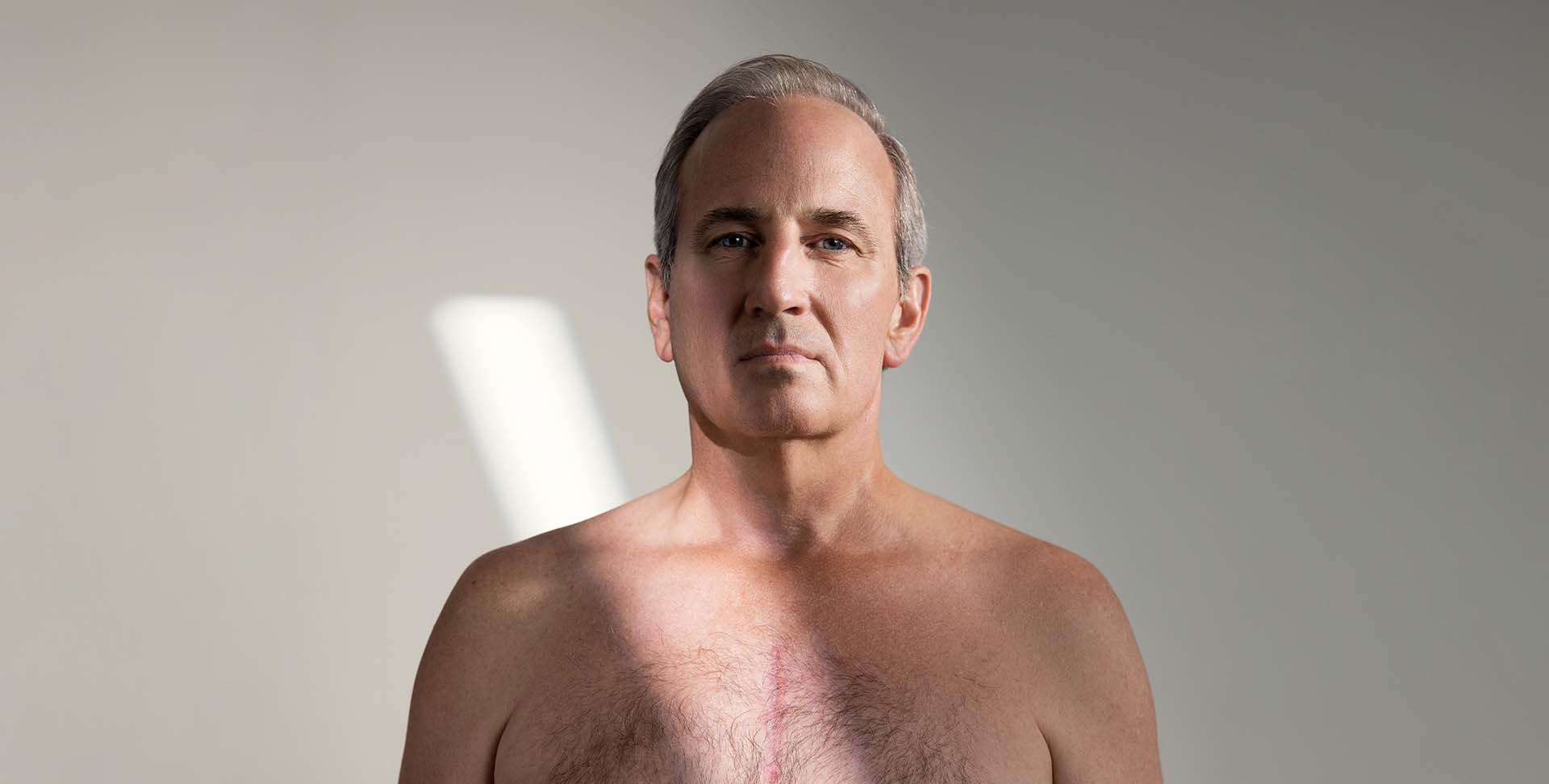 Paul King montre la cicatrice de l’incision pratiquée lors de sa chirurgie cardiaque.