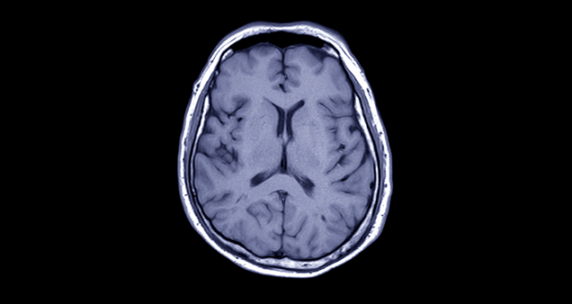 Image de scan du cerveau
